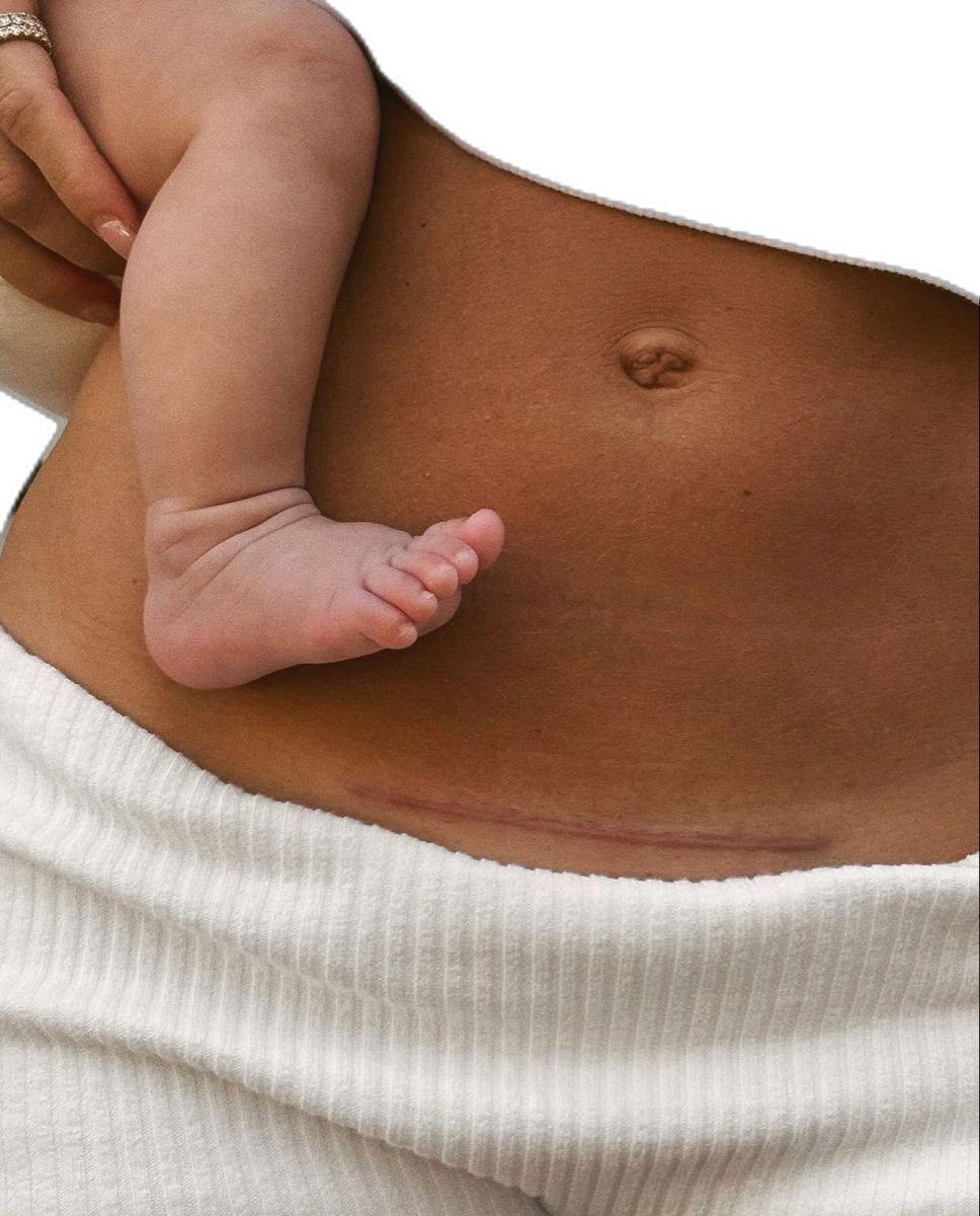 Problema: Cicatriz de cesárea